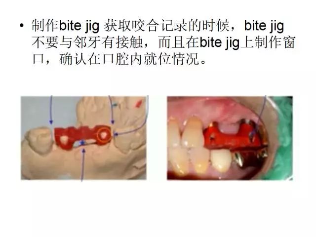 【牙医学堂】修复中咬合记录技巧