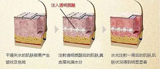 答案:可以联合使用,但有间隔期,因注射层次不同 肉毒素和玻尿酸在除皱