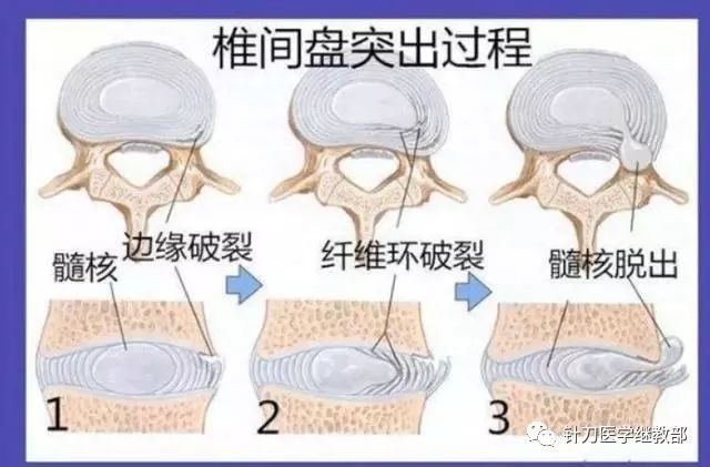 腰突人口_人口普查