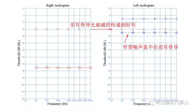 纯音测试手把手教你做骨导掩蔽