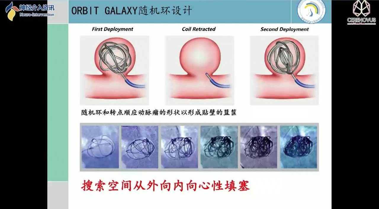 强生医疗cnv神经介入专栏丨张庆荣教授galaxy弹簧圈在小动脉瘤栓塞术