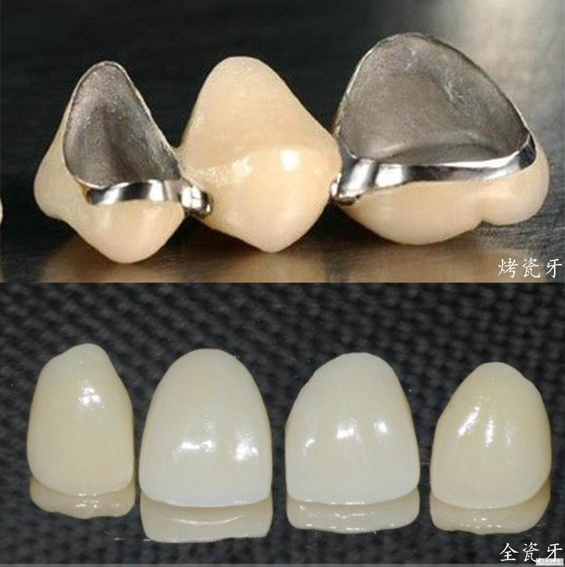 烤瓷牙拆除后全瓷牙重新修复前后对比。-健康160