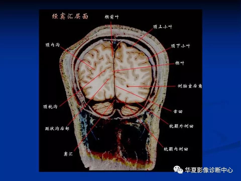 各部位详细标注的大脑断层解剖