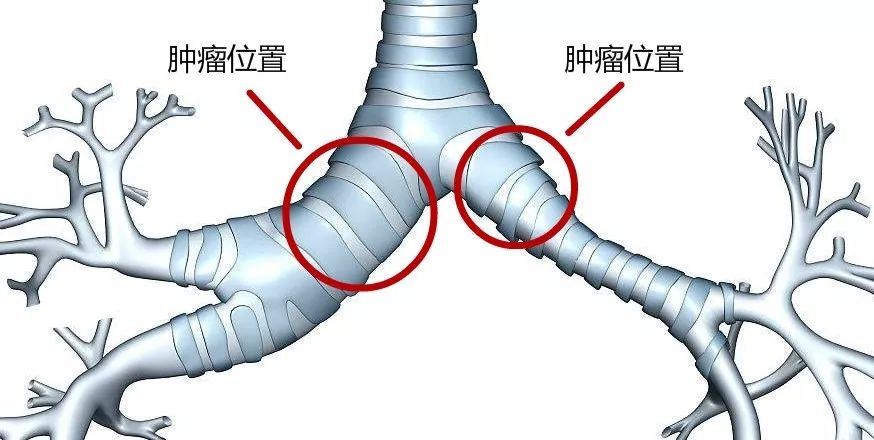 老王的肿瘤刚好长在左右气管分叉处,把左边和右边的气管同时堵住大