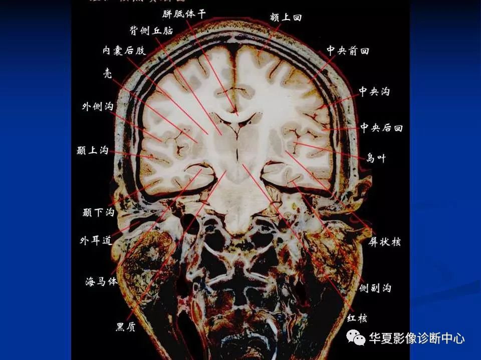 各部位详细标注的大脑断层解剖
