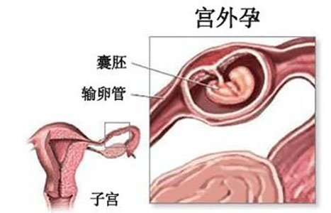 宫外孕是否能用试纸查出来