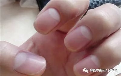 一般年轻人大拇指的半月痕是指甲的1/5,边缘清晰.