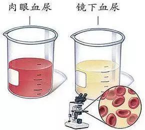 突发无痛性肉眼血尿,尿色加深如浓茶色或洗肉水样,持续时间数小时到数