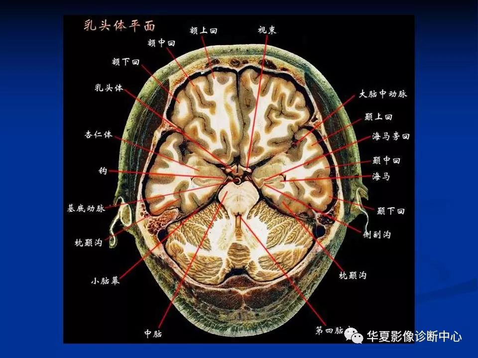 各部位详细标注的大脑断层解剖