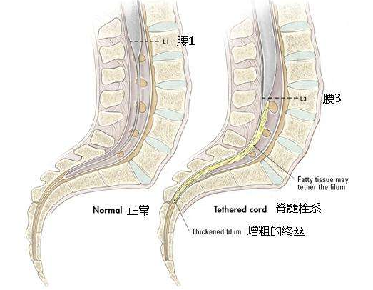 脊髓栓系综合征可以不手术吗?