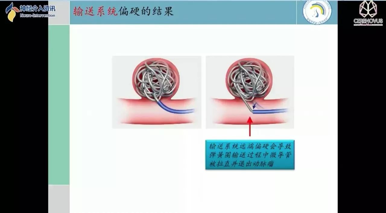 强生医疗cnv神经介入专栏丨张庆荣教授galaxy弹簧圈在小动脉瘤栓塞术