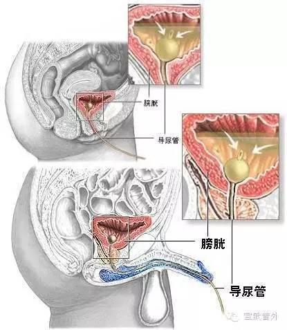 导尿管留置护理常识