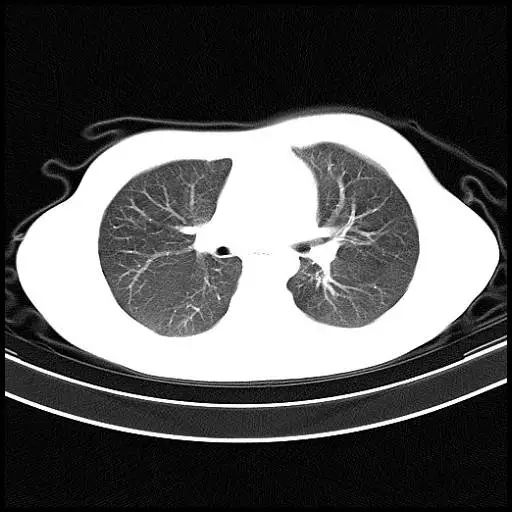 正常肺的ct表现