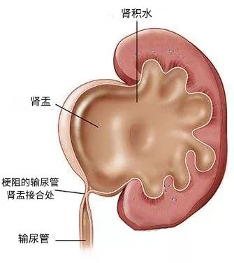 当然,如果做b超时,胎儿正好憋着一泡尿,也可能发生肾盂分离.