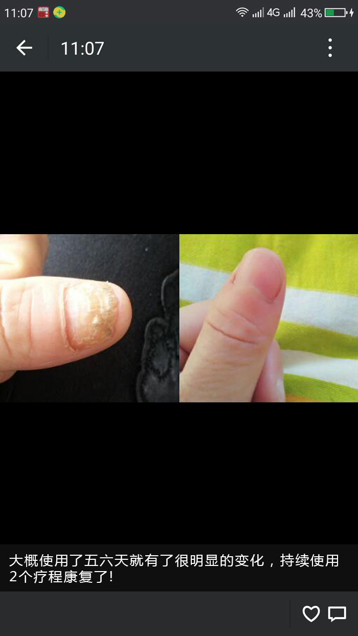 怎样治疗灰指甲亲述灰指甲治疗方法哪种有效