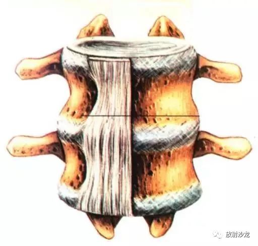 侧隐窝下部为骨性部,其前为椎体后面;后为椎板峡部;内侧为硬膜囊