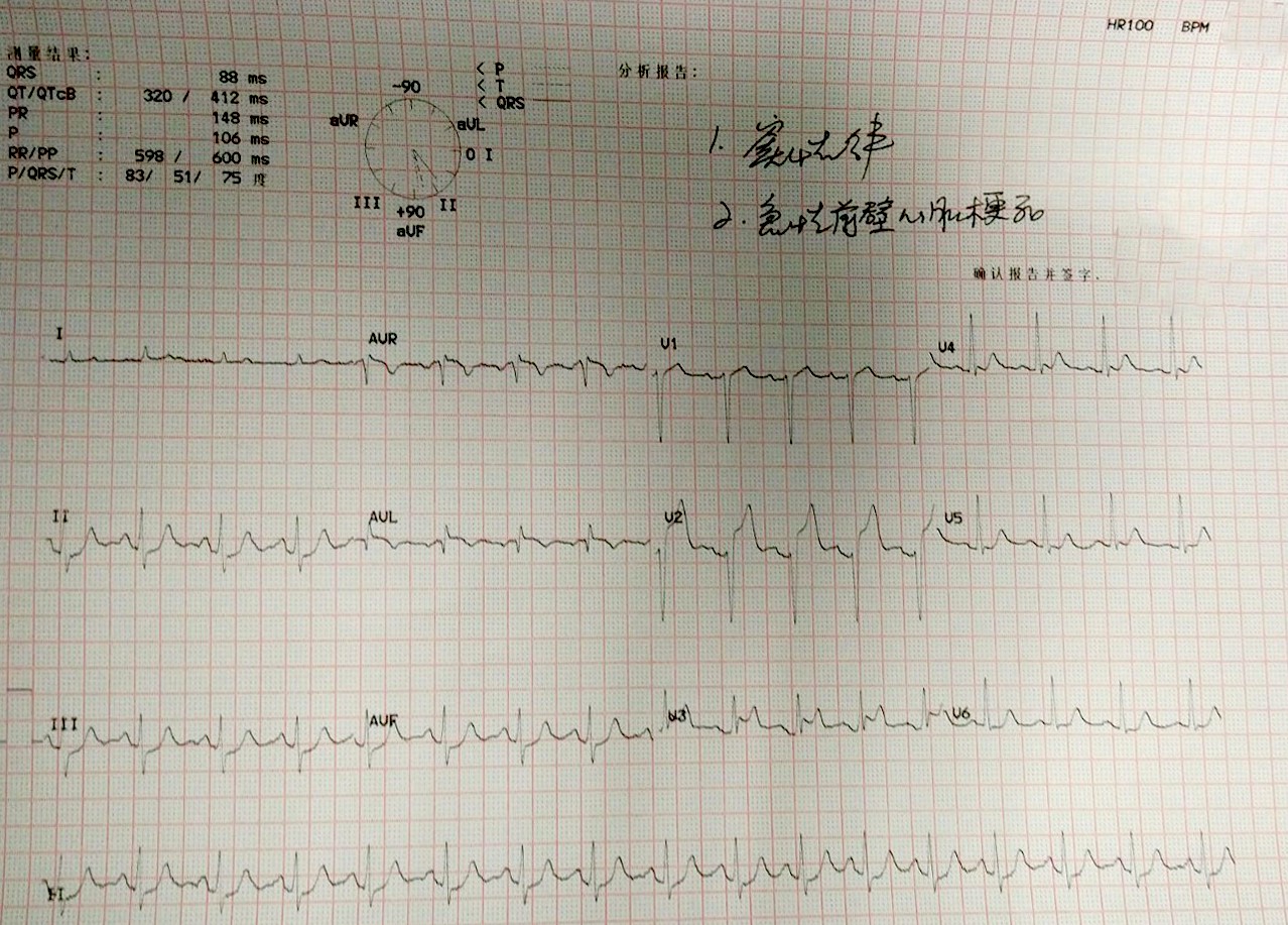 案例分析心脏超声造影在急性心梗围手术期的应用