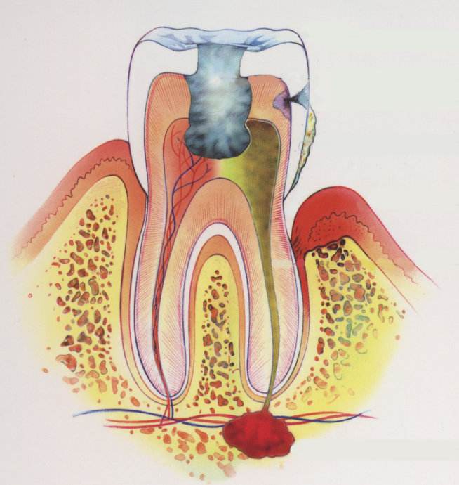 牙髓炎有哪些症状?