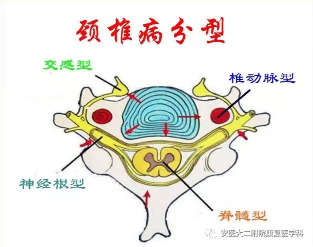 首先有颈椎基础病变:骨质增生,椎间盘突出,颈椎小关节紊乱等.