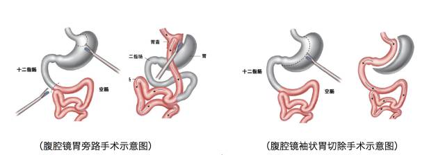 早期肠内营养在胃切除术后的应用