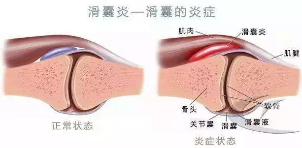 收藏帖 | 滑囊炎不可怕,可怕的是你不知道这些