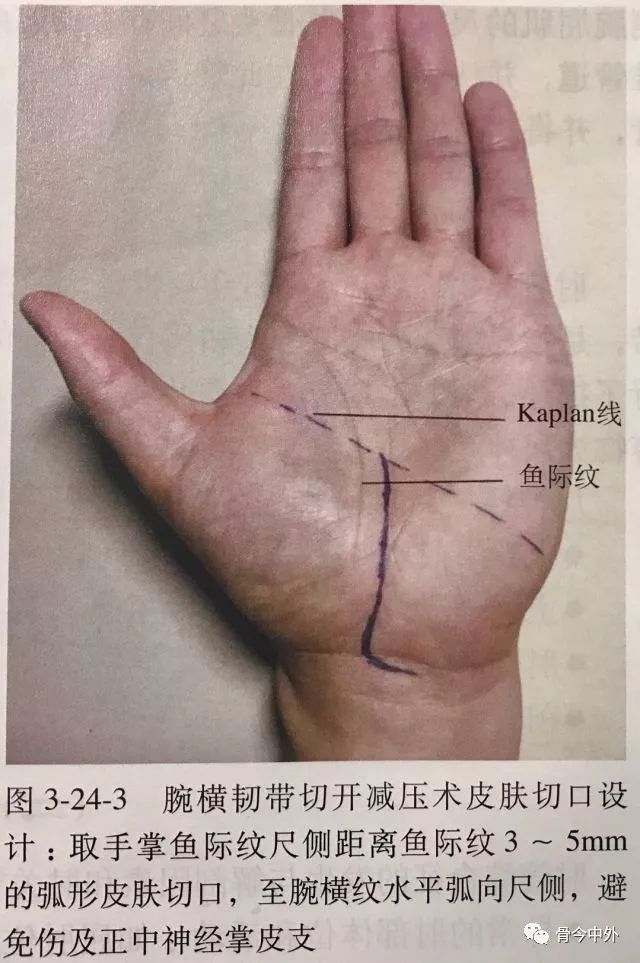 腕管综合征病因分析及手术处理方法精要