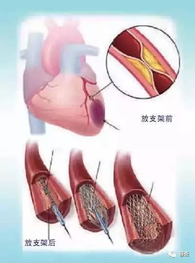 容斋分享 心脏支架 支不起生命,架不了健康?