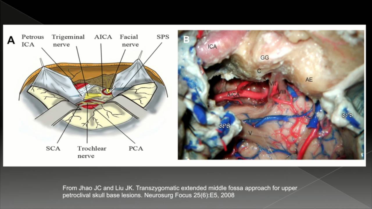 【正海-妙术视界 james liu教授:扩大中颅窝入路切除岩斜区脑膜瘤