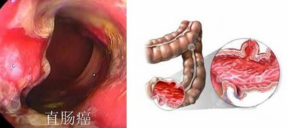 这关键分辨痔疮或大肠癌教育