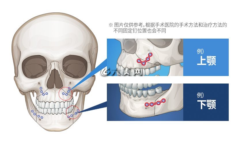 形状,功能上出现问题时,调整上颌(上颚)与下颌(下颚)