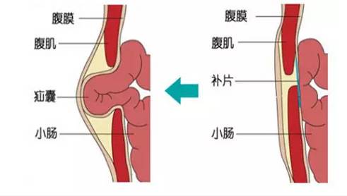 那好,这个话题 我今天就来一次说个透 腹股沟疝 老百姓又称"疝气