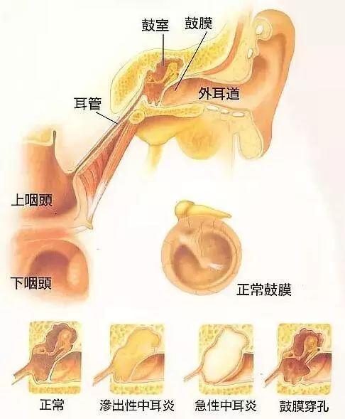 中耳炎反反复复,你的耳朵还好吗?