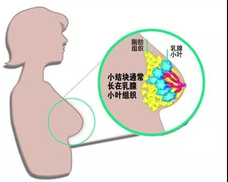 乳房里的"结",怎样"解"?