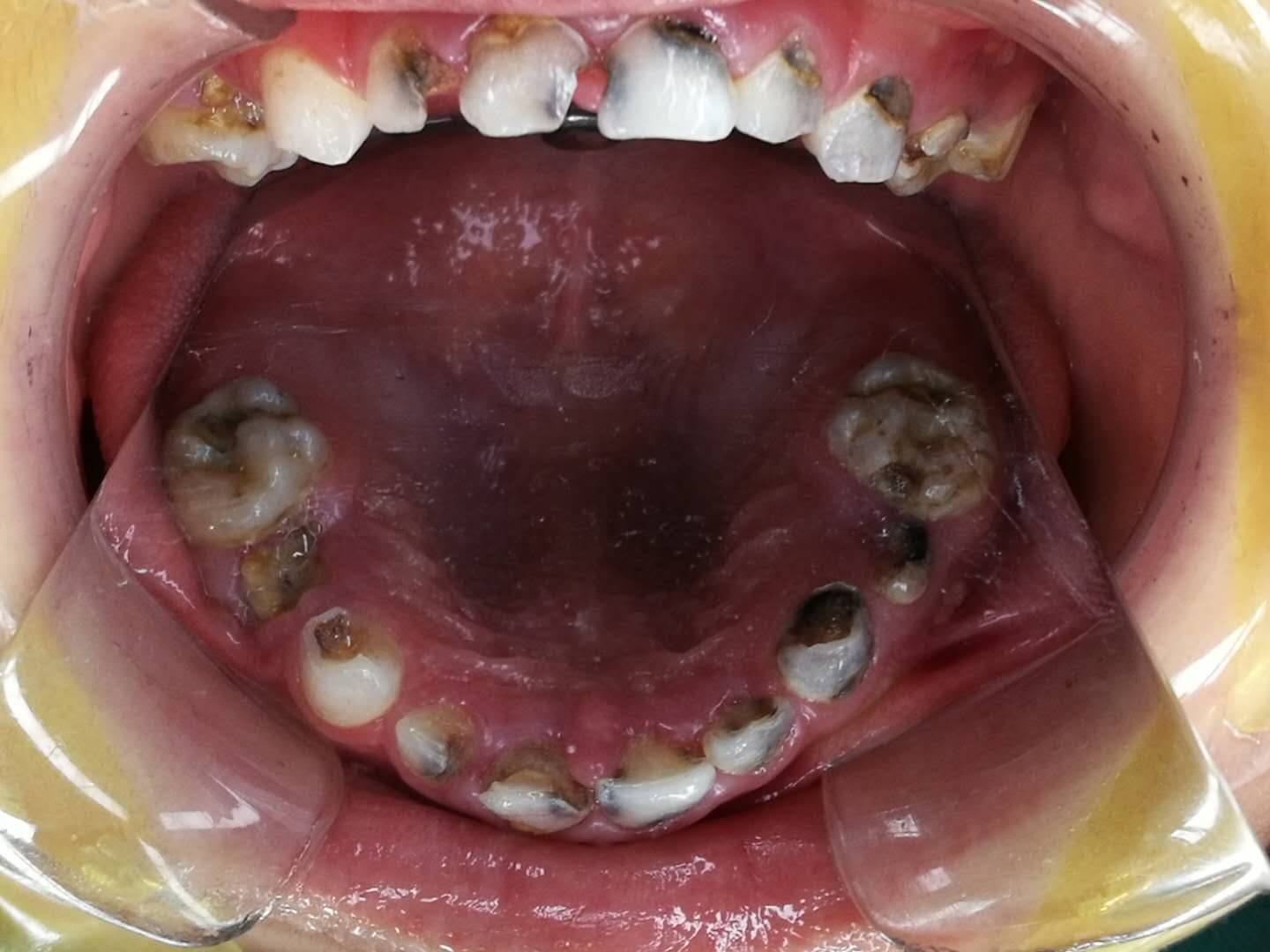 植牙牙根跟骨肉修復 - 至美牙醫診所