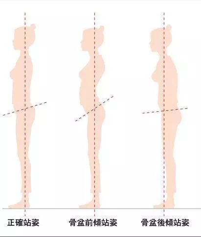二,骨盆前倾或后倾