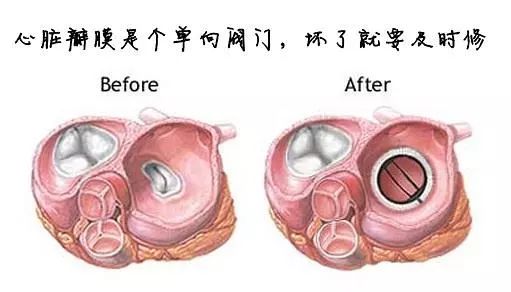 手术现场直击发热咳嗽要留意可能是心脏瓣膜病的信号