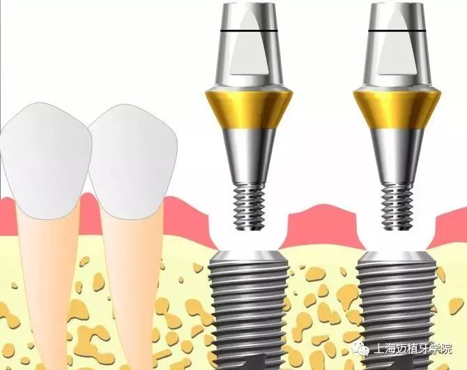 口腔种植印模/种植修复取模图解