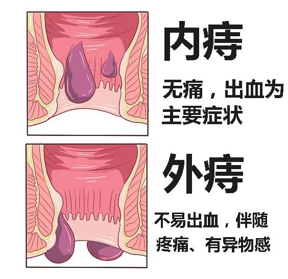 刚刚发现有痔疮怎么办