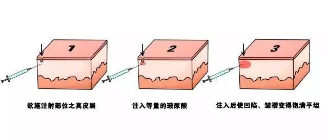 除皱针 玻尿酸=时光穿梭机!为青春疯狂打call!