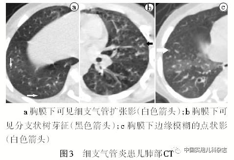 此外,还可见弥漫性泛细支气管炎(dpb,闭塞性细支气管炎(bo)以及婴儿