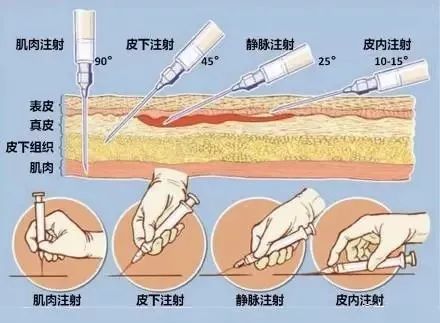 回血则表示注射部位正确可以注射;如果没有回血,表示针头未进入静脉中