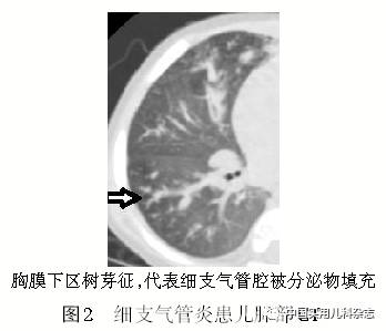 专题笔谈│细支气管炎影像学特征