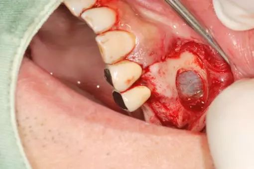 牙槽骨修整术的适应证有:拔牙后牙槽骨吸收不全,骨尖,嵴有压痛者,应