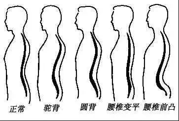 5个少儿常见不良体态,最后一个会毁了孩子一生