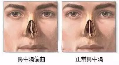 鼻中隔偏曲就是人在发育过程中鼻中隔受某些因素影响导致的结构上的