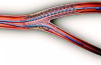 心脏支架手术治疗的过程是穿刺血管,使导管在血管中前行,到达冠状动脉