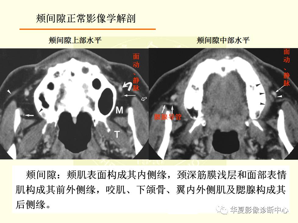 颊间隙影像学解剖与病变的诊断