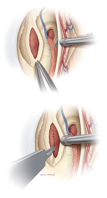 经胼胝体穹窿间入路手术策略与技巧 | the neurosurgical atlas全文