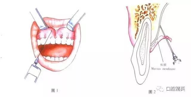 口腔常用麻醉方法