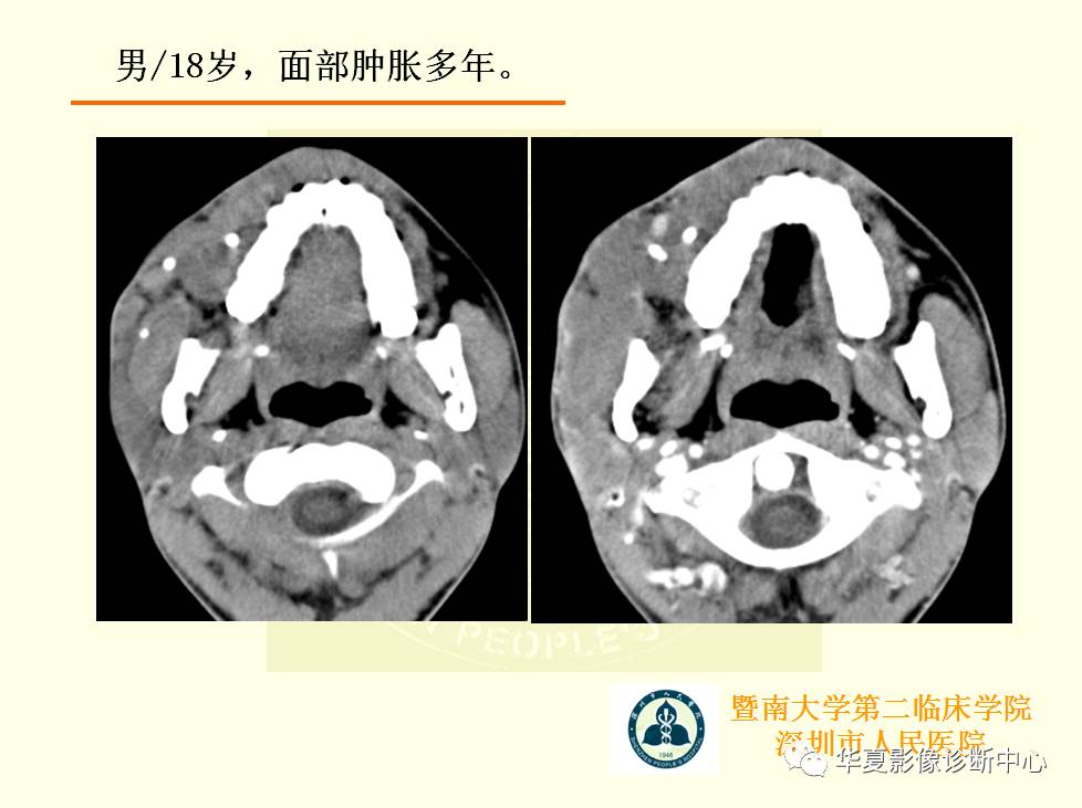 颊间隙影像学解剖与病变的诊断